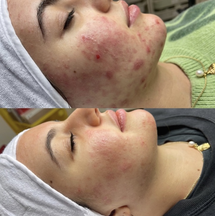 Female client with acne laying down for a before and after photo of her treatments