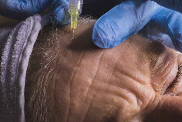 A woman with naturally ageing skin, having injections into the forehead by a dermatologist.
