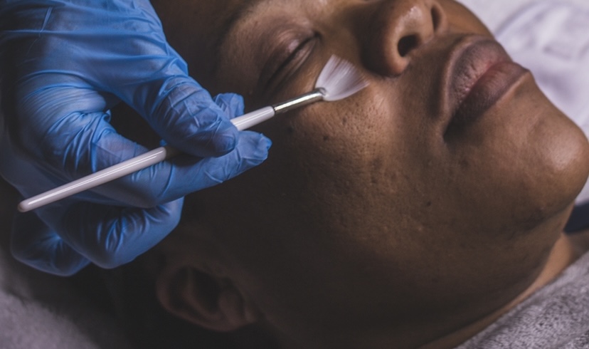 A hyperpigmentation treatment being done using the pHformula resurfacing products