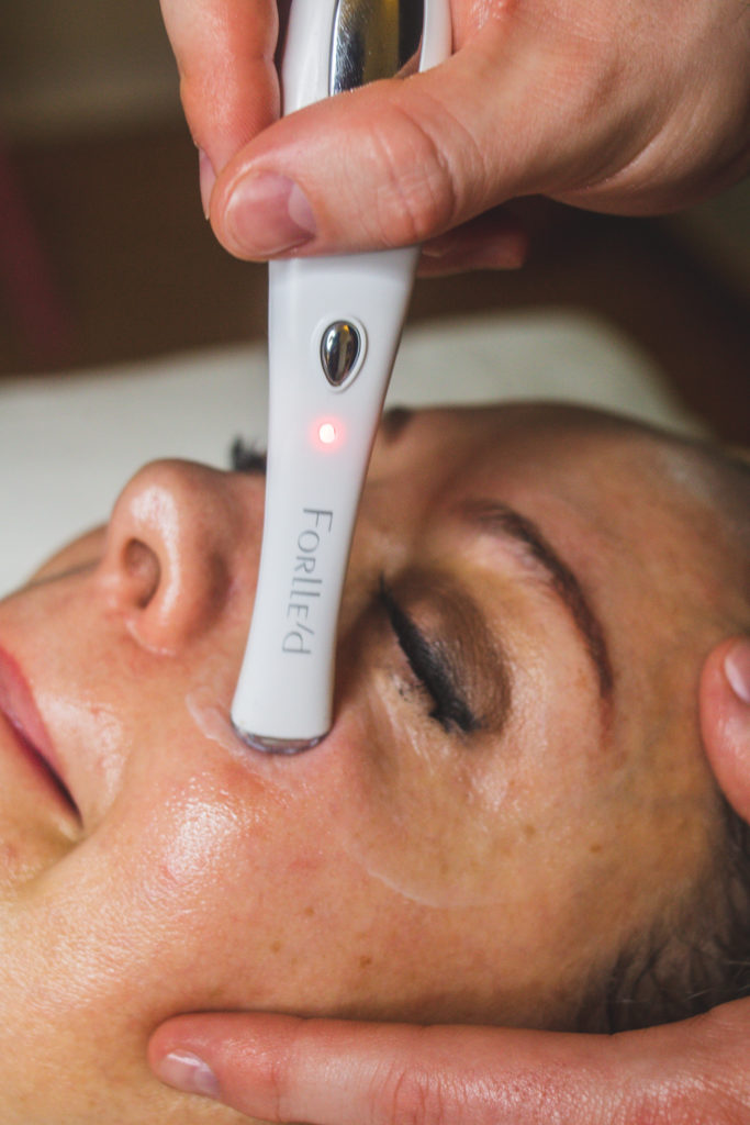 Image of Ané getting a mini-peel done. A resurfacing treatment that helps reduce the signs of ageing.
